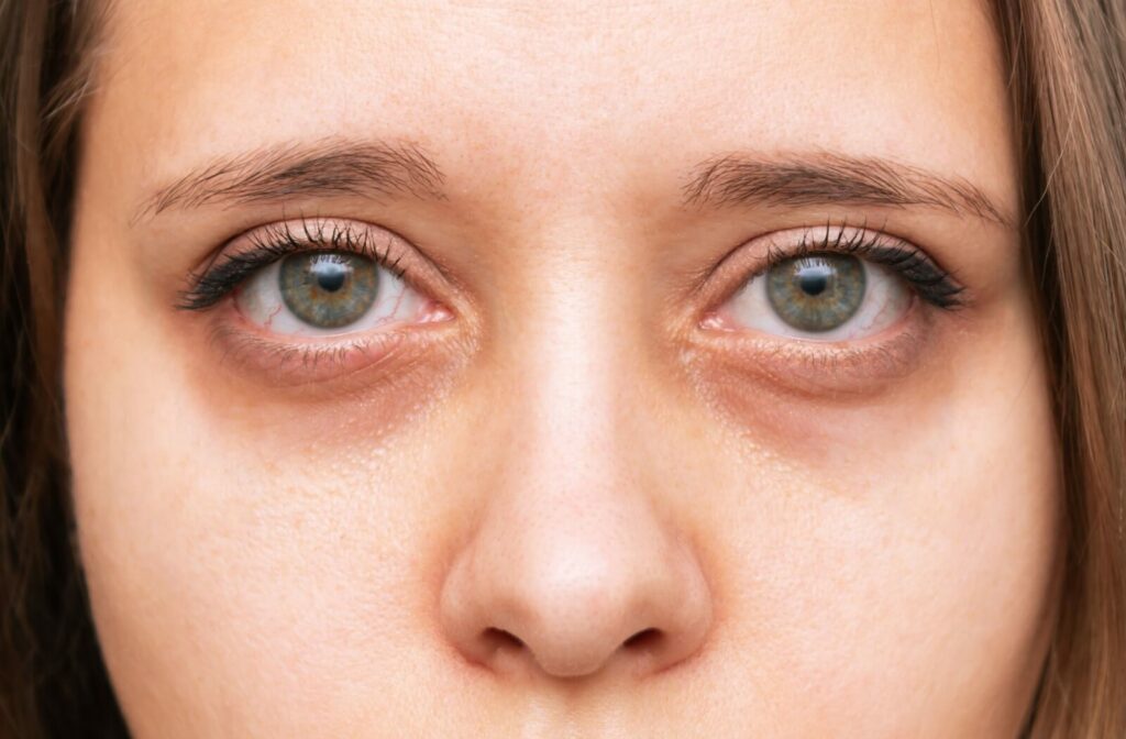 A close-up of a person’s eyes showing slight redness and puffiness under the lower eyelids from eye strain.